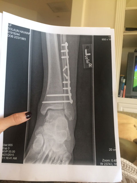 X-ray confirming the break in Havana Solaun's leg. (Havana Solaun)